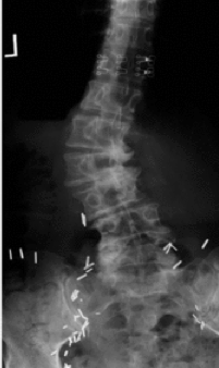 Degenerative Scoliosis - Preferredpaincenter